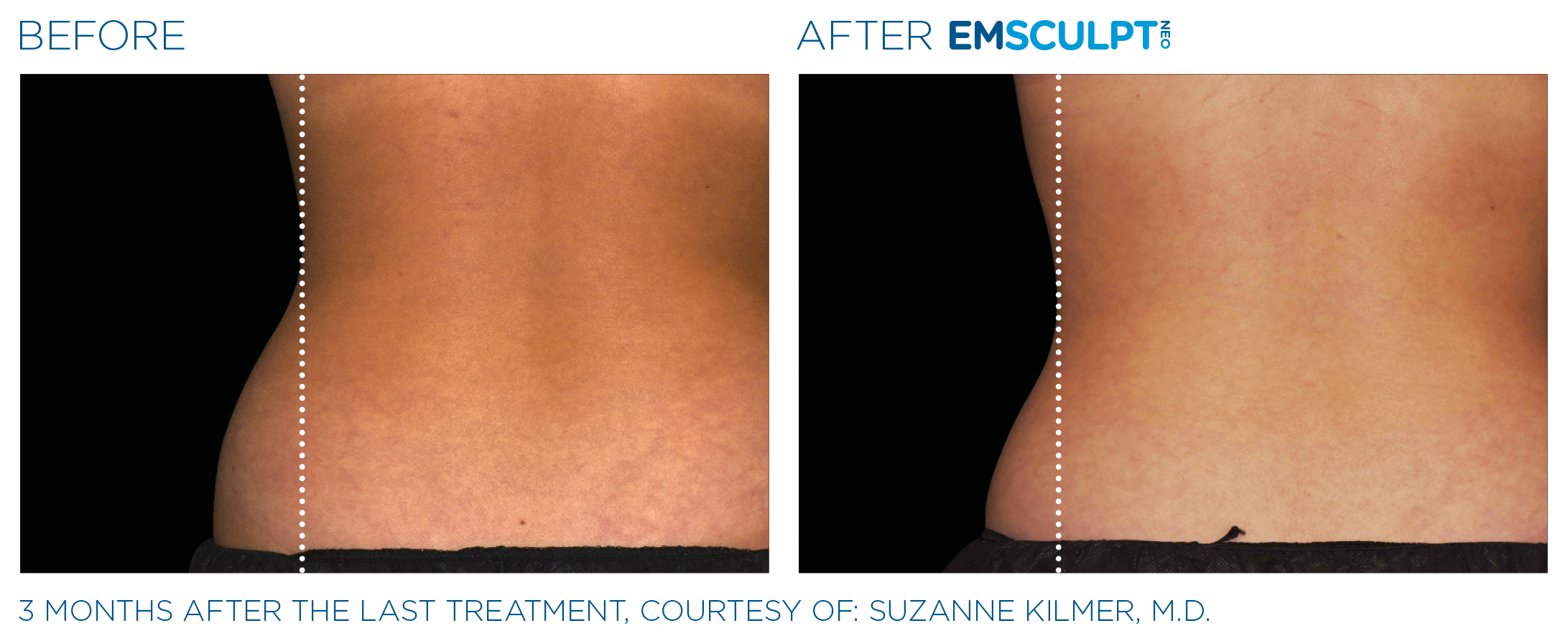 Emsculpt_Neo_PIC_Ba-card-female-lateral-abdomen-176_ENUS100