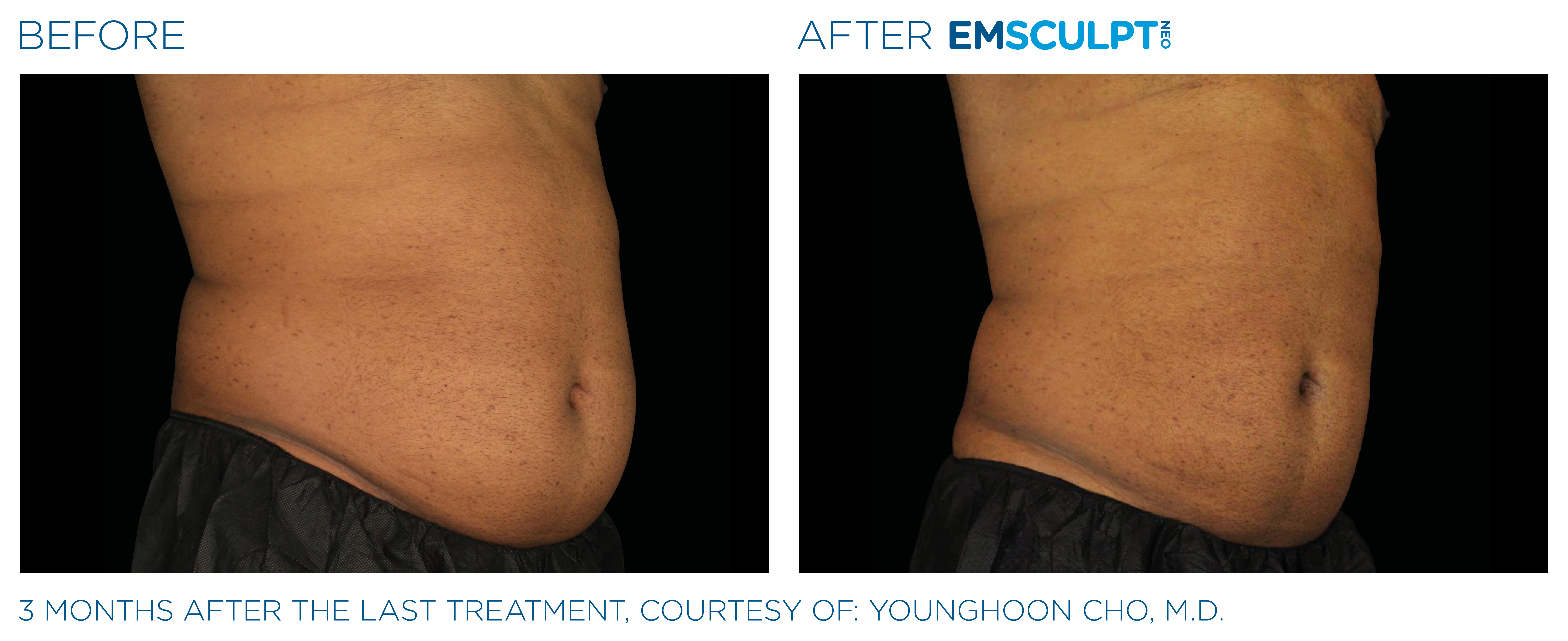 Emsculpt_Neo_PIC_Ba-card-male-lateral-abdomen-149_ENUS100
